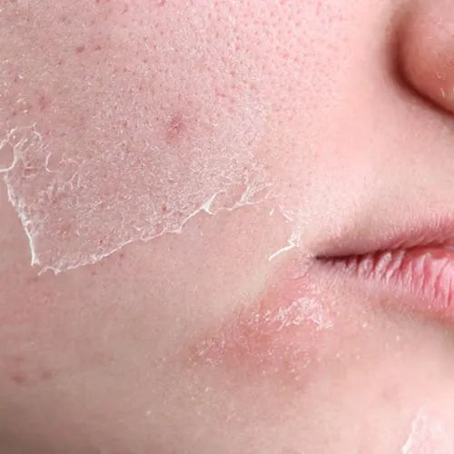 Dry Skin