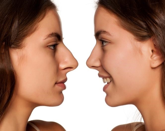 thick skin rhinoplasty expert