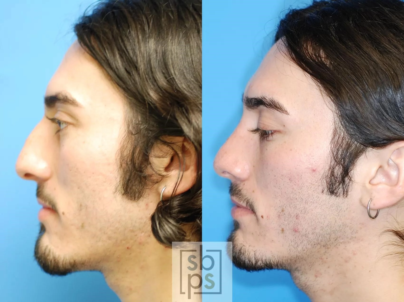 thick skin rhinoplasty expert